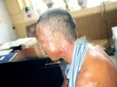 老年人白癜风要有哪些护理常识