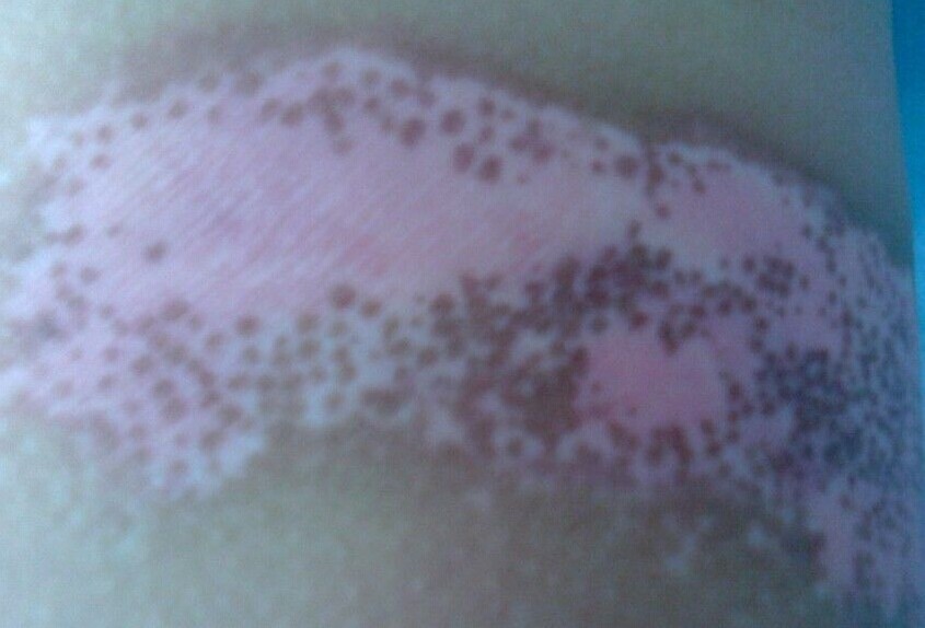 白癜风治疗不要掉入陷阱