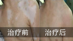 胸部长有白癜风生活中应注意什么