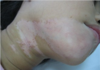 白癜风治疗中的护理常识有什么