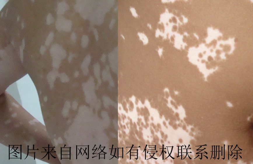 白癜风有何养生疗法呢