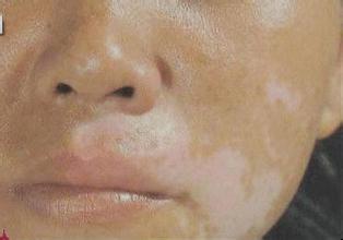 白癜风患者可以吃冬瓜么