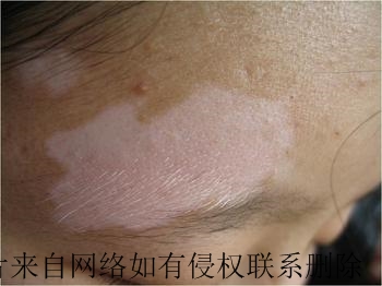 白癜风患者冬季应有的护理常识