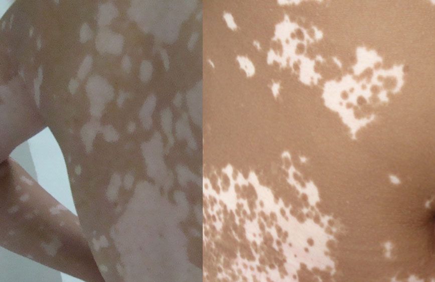 白癜风预防有哪些注意点