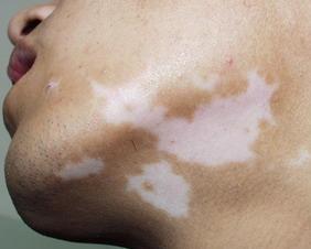 夏季白癜风如何做护理