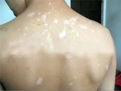 泛发型白癜风的症状表现有哪些呢