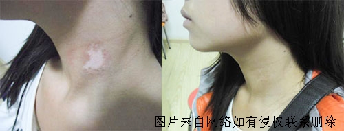 青少年白癜风初期有什么症状呢