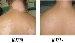 白癜风是如何分类的