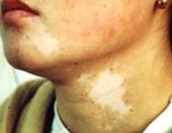 白癜风的症状特点有哪些呢