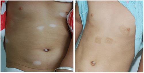 究竟白癜风带来哪些并发症