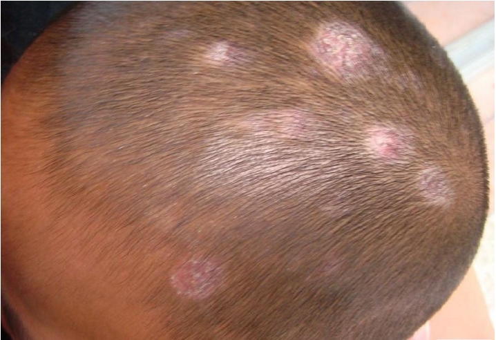 白癜风给患者带来哪些深刻危害