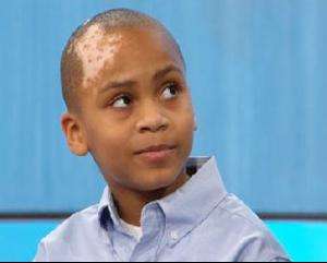 节段型白癜风会带来哪些危害呢