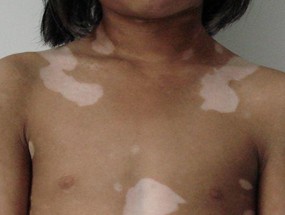 白癜风会传染给他人么