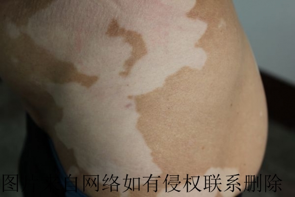 白癜风为何会发病呢