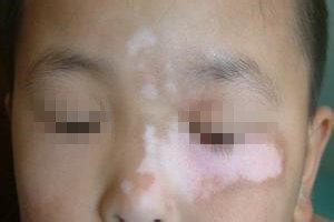 冬季治疗白癜风的优势有哪些