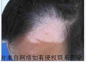 老年白癜风如何进行治疗呢