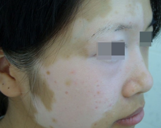 男性白癜风治疗时候注意哪些呢