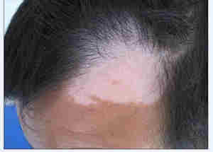 广州白癜风治疗应该选择哪家医院