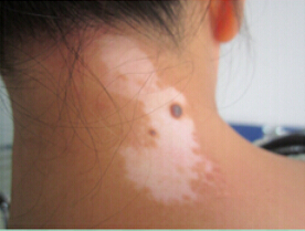 白癜风的正确治疗方法有哪些