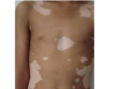 白癜风总是治不好的原因是什么