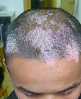 儿童白癜风晚期症状表现有哪些呢