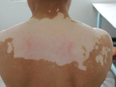 儿童患白癜风如何进行治疗更好