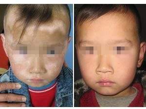 孩子白癜风治疗好注意哪些步骤