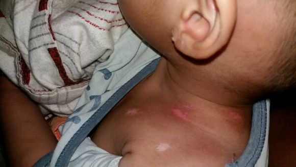 面部白癜风的致病原因有哪些呢