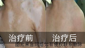 白癜风患者要如何护理与治疗